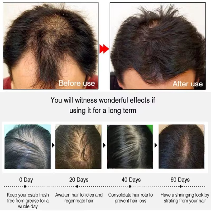速効性ジンジャーヘアグローススプレー、毛根育成、脱毛防止、育 - Hair Care For Hair Loss のレビューと価格